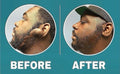 Keloid Dissolver Oil